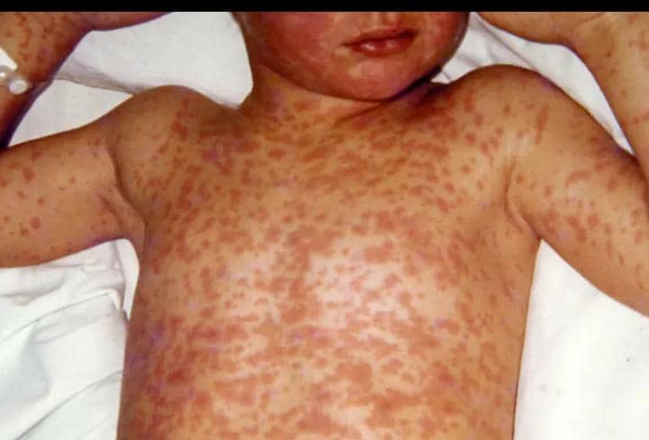Measles Outbreak Confirmed in Kumi District as Six Children Test Positive